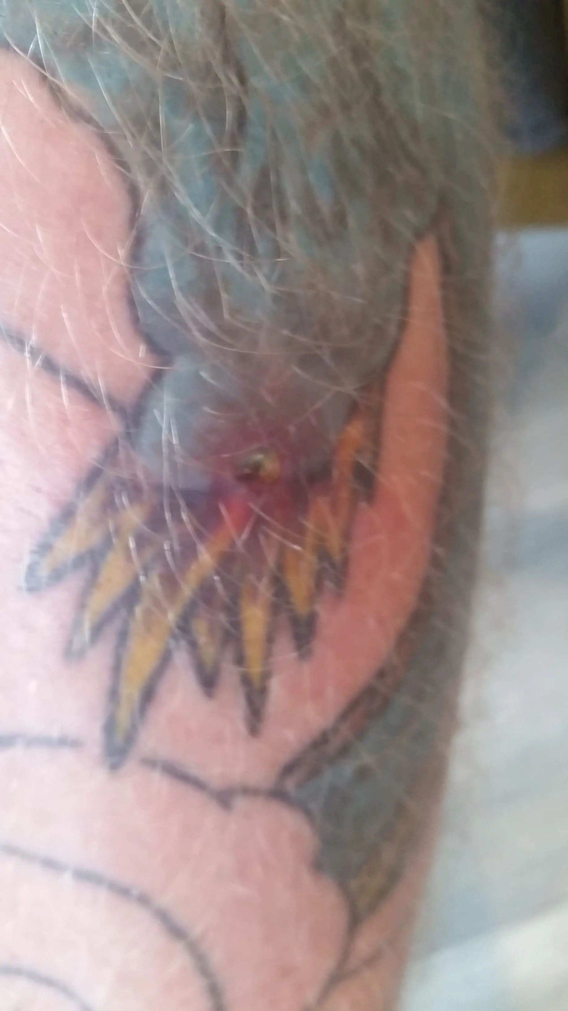 the infection, before getting antibiotics, looks small but totally deadly.